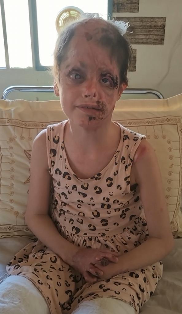 Luana, 14 anos, durante os cuidados com a pele afetada pelo penfigoide bolhoso